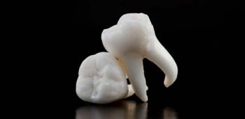 歯の侵食の解析における新手法の評価